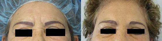 Brow Lift before and after photo by Hughes Plastic Surgery in Los Angeles, CA