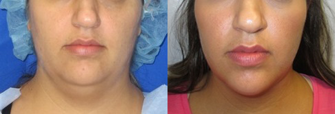 Chin Liposuction before and after photo by Hughes Plastic Surgery in Los Angeles, CA
