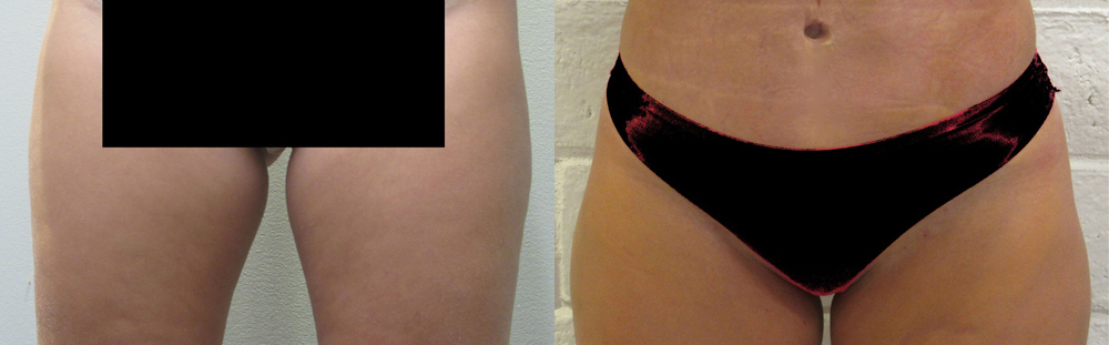Inner Thighs before and after photo by Hughes Plastic Surgery in Los Angeles, CA