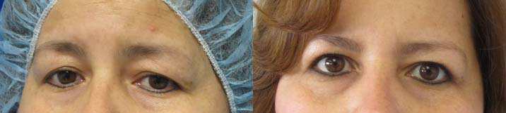 Eyelid Surgery before and after photo by Hughes Plastic Surgery in Los Angeles, CA