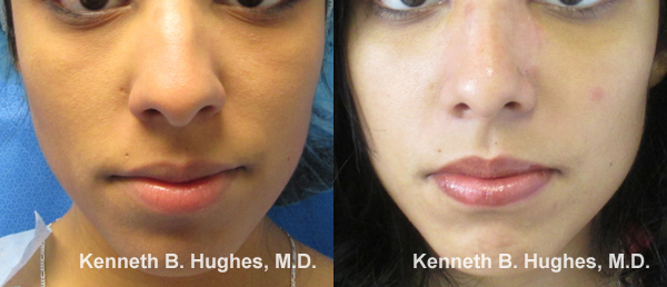 Rhinoplasty before and after photo by Hughes Plastic Surgery in Los Angeles, CA