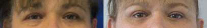 Eyelid Surgery before and after photo by Hughes Plastic Surgery in Los Angeles, CA