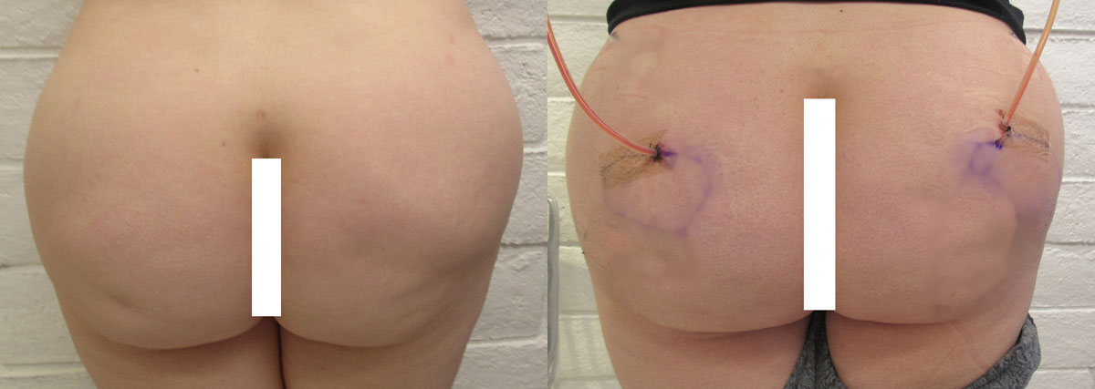 Fat Necrosis and Dead Fat Removal before and after photo by Hughes Plastic Surgery in Los Angeles, CA