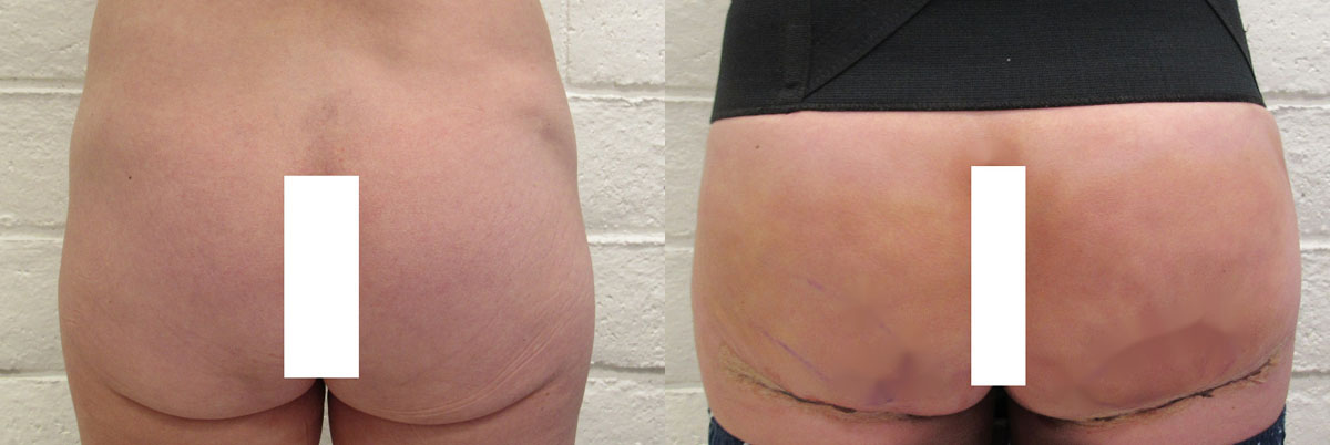 Fat Necrosis and Dead Fat Removal before and after photo by Hughes Plastic Surgery in Los Angeles, CA