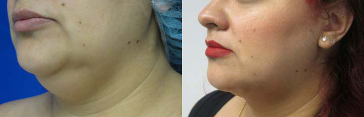 Neck Lift before and after photo by Hughes Plastic Surgery in Los Angeles, CA
