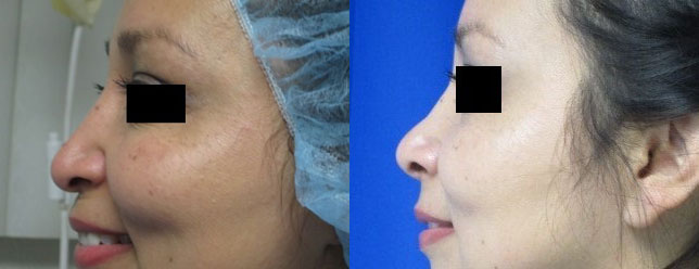 Rhinoplasty before and after photo by Hughes Plastic Surgery in Los Angeles, CA