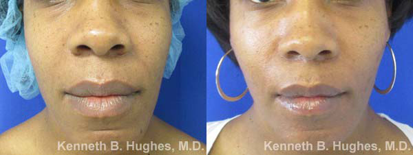 Facial Fat Grafting and Stem Cell Rejuvenation before and after photo by Hughes Plastic Surgery in Los Angeles, CA